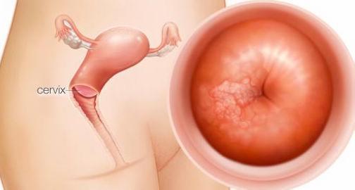海外医疗科普：不同年龄段宫颈癌筛查方案解读