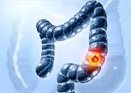 人工合成菌群有望缓解结直肠癌